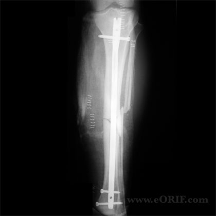 Tibial shaft IM nail xray