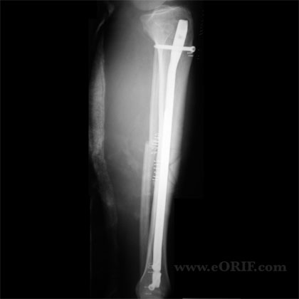 Tibial shaft lateral view IM nail xray