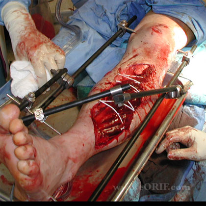 Tibial shaft external fixation image