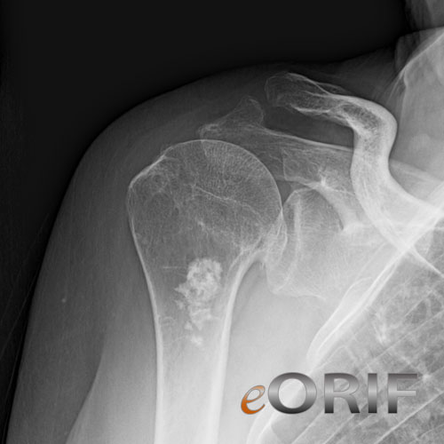 rotator cuff arthropathy image