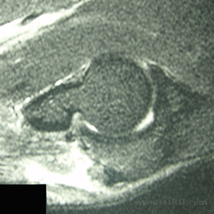 triceps tendon rupture mri