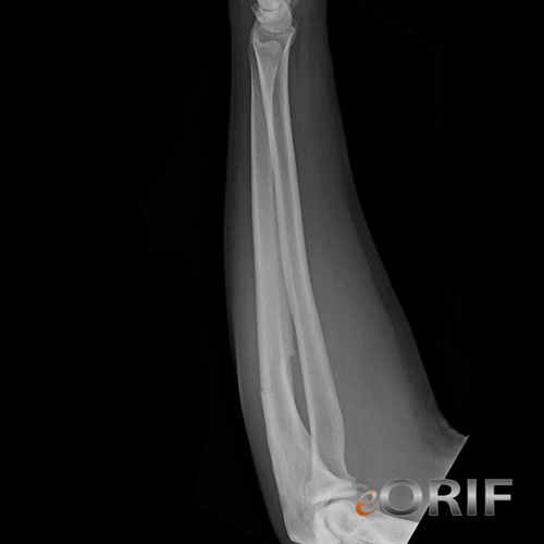 ulnar shaft fracture