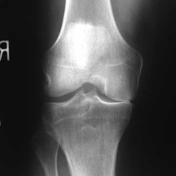 medial compartment arthritis xray