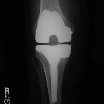 revision unicompartmental knee xray