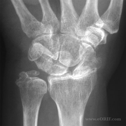 wrist arthritis xray pic