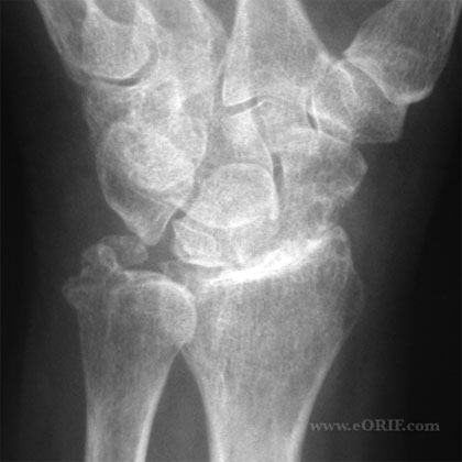 wrist arthritis xray